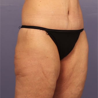 45-54 year old woman treated with Body Lift after 3666050