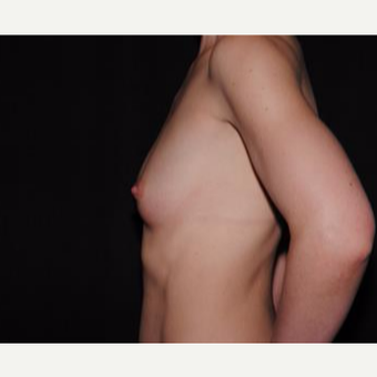 25-34 year old woman treated with Breast Implants before 3593680