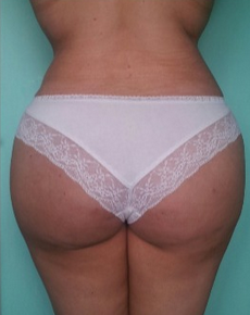 Preoperatively, the buttocks are literally inverted (V-shape). after 1800394