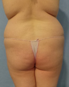 Preoperatively, the buttocks are literally inverted (V-shape). before 1800394