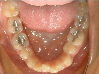 Invisalign treatment for rotated, uneven teeth 881822
