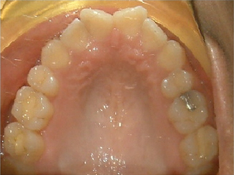 Invisalign treatment for rotated, uneven teeth before 881822