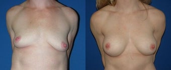 38 year old woman treated with Breast Augmentation before 2990478