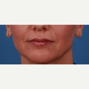 45-54 year old woman treated with Juvederm before 2185788