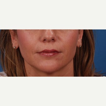 45-54 year old woman treated with Juvederm after 2185788