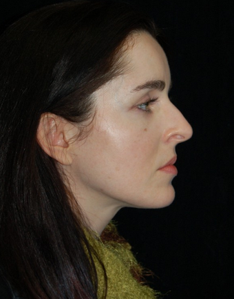 Nose Surgery - Rhinoplasty before 1253154