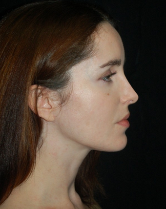 Nose Surgery - Rhinoplasty after 1253154