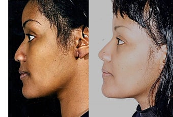 35-44 year old woman treated with African American Rhinoplasty 1690768