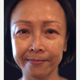 45-54 year old woman treated with Injectable Fillers after 3243240