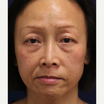 45-54 year old woman treated with Injectable Fillers before 3243240