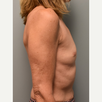 55-64 year old woman treated with Breast Augmentation before 3304913