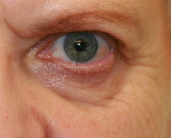 Laser Lower Eyelid Skin before 1174480
