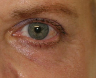 Laser Lower Eyelid Skin after 1174480