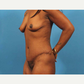 35-44 year old woman treated with Mommy Makeover after 3787091