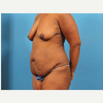 35-44 year old woman treated with Mommy Makeover before 3787091