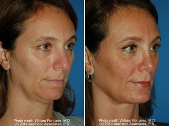 Neck Liposuction before 1389718