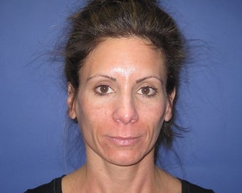 42 Year Old Seeks Minifacelift and Laser Resurfacing before 1475223