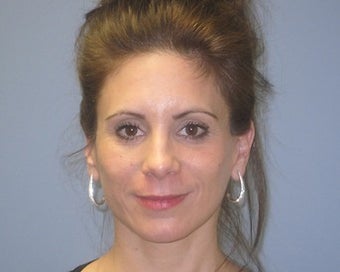42 Year Old Seeks Minifacelift and Laser Resurfacing after 1475223