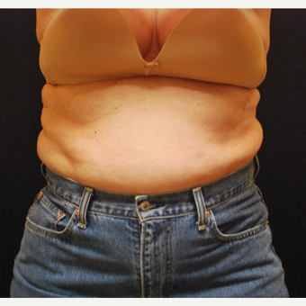 45-54 year old woman treated with Vanquish ME before 3500346