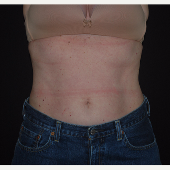 45-54 year old woman treated with Vanquish ME after 3500346