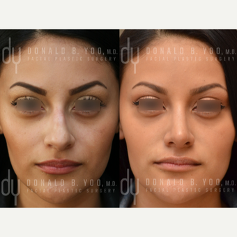 Primary Open Rhinoplasty and Septoplasty before 3322571