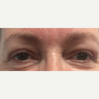 55-64 year old woman treated with Eyelid Surgery after 3493705