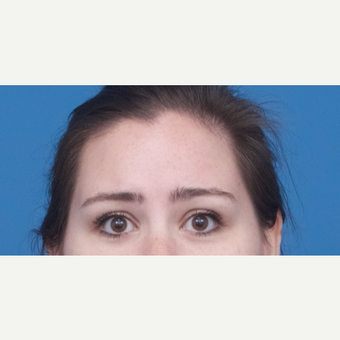 18-24 year old woman treated with Dysport after 3764330