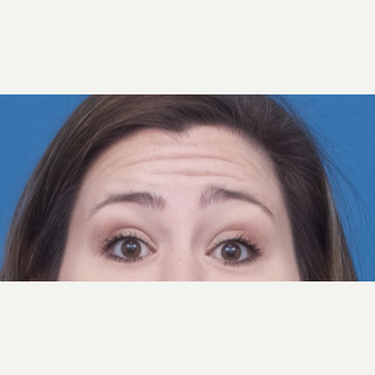 18-24 year old woman treated with Dysport before 3764330
