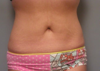 Body Jet and Slim Lipo after 208641