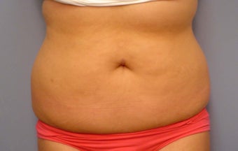 Body Jet and Slim Lipo before 208641