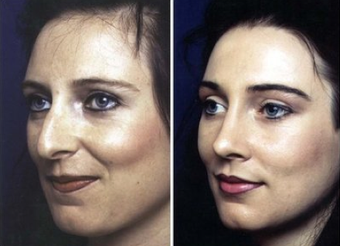 Rhinoplasty before 92269