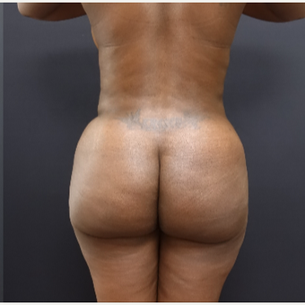 35-44 year old woman treated with Butt Augmentation after 3200912