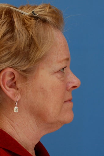 Face & Neck Lift, Facial Fat Grafting, Upper and Lower Eyelid Lifts, Perioral Dermabrasion before 551962