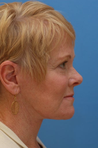 Face & Neck Lift, Facial Fat Grafting, Upper and Lower Eyelid Lifts, Perioral Dermabrasion after 551962