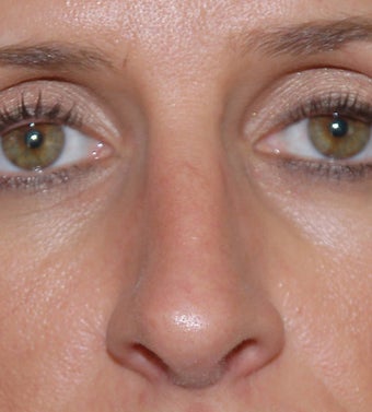 Open Rhinoplasty after 182602