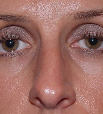 Open Rhinoplasty before 182602