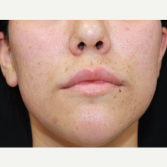 27 year old woman treated with Juvederm to lips and nasolabial folds before 3059597