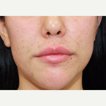 27 year old woman treated with Juvederm to lips and nasolabial folds after 3059597