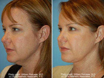 Neck Liposuction before 1389490