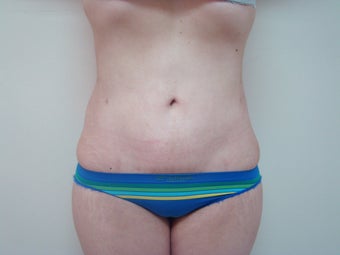 Liposculpture on abdominal fat after 88870