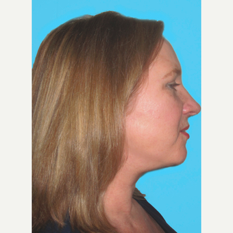 Facelift after 3826857