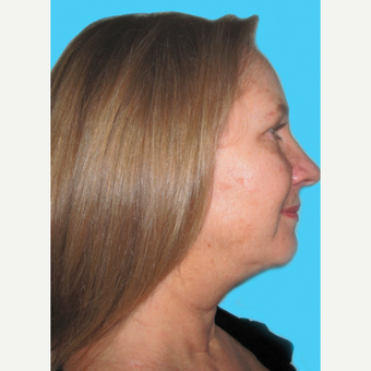 Facelift before 3826857