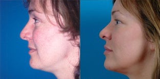36-year-old woman treated with Facial Fat Transfer. after 3282125