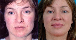 36-year-old woman treated with Facial Fat Transfer. before 3282125