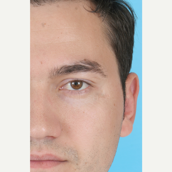 25-34 year old man treated with Ear Surgery after 3703150