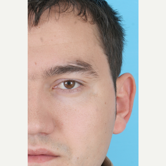 25-34 year old man treated with Ear Surgery before 3703150