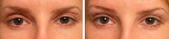 Injectable Treatments before 1200514