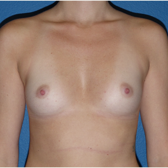 18-24 year old woman treated with Breast Augmentation before 3081336