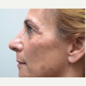 45-54 year old woman treated with Rhinoplasty after 3747724