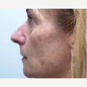 45-54 year old woman treated with Rhinoplasty before 3747724